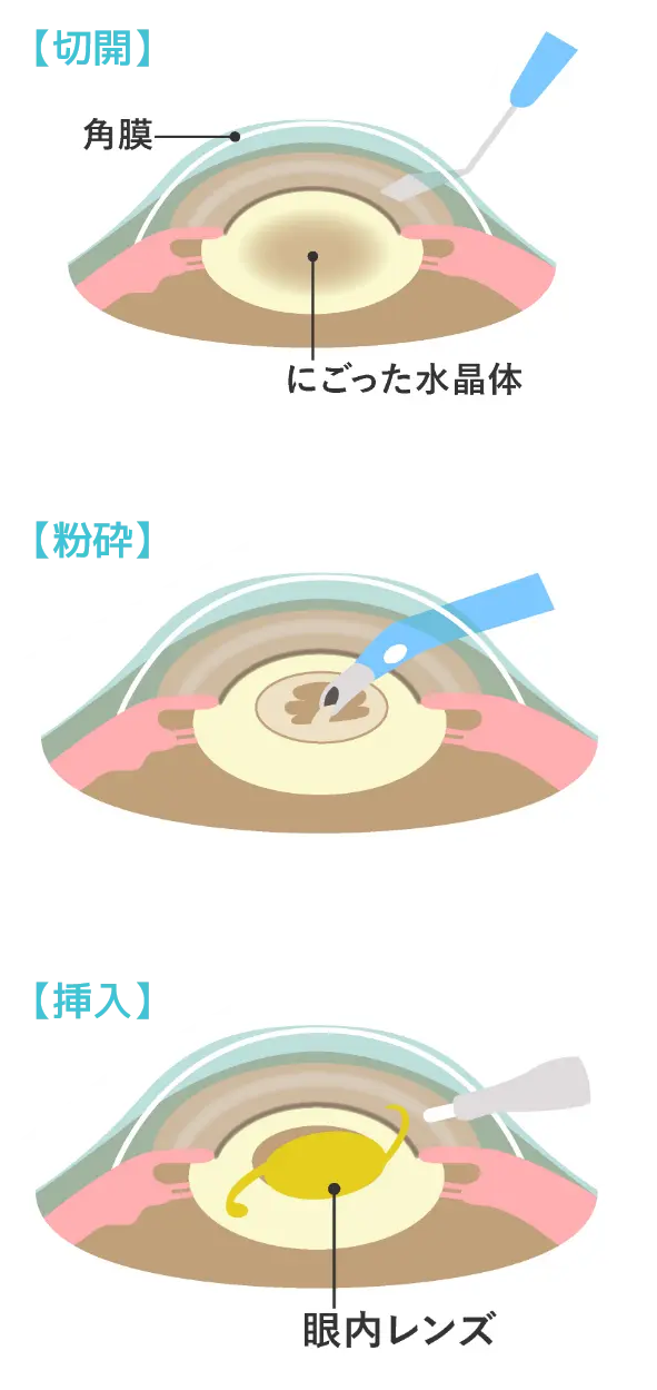 切開、粉砕、挿入の図