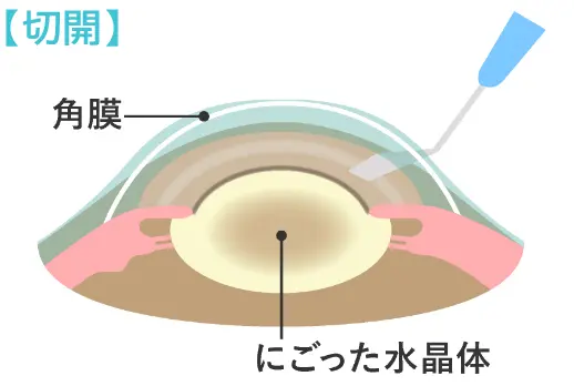 切開の図