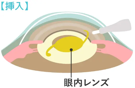 挿入の図